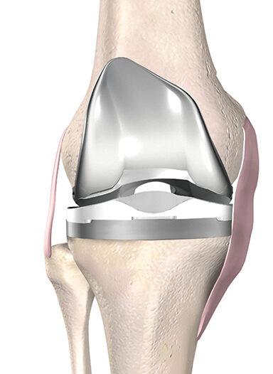 knee-assisted-surgery